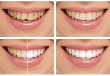 All about Cosmetic Dentistry