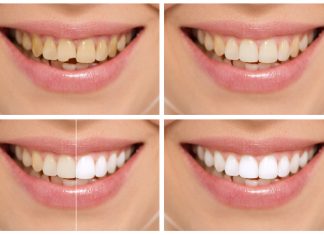 All about Cosmetic Dentistry