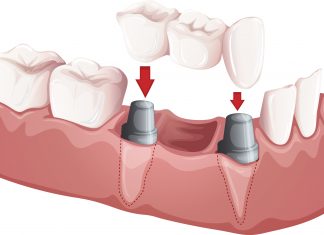 What are Crown and Bridges?