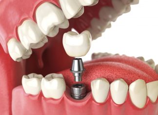 Short info on Dental Implants